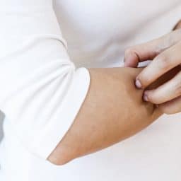 Woman scratching her arm.