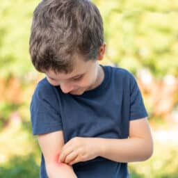 Child scratching and looking at his arm because it itches in a park with green background