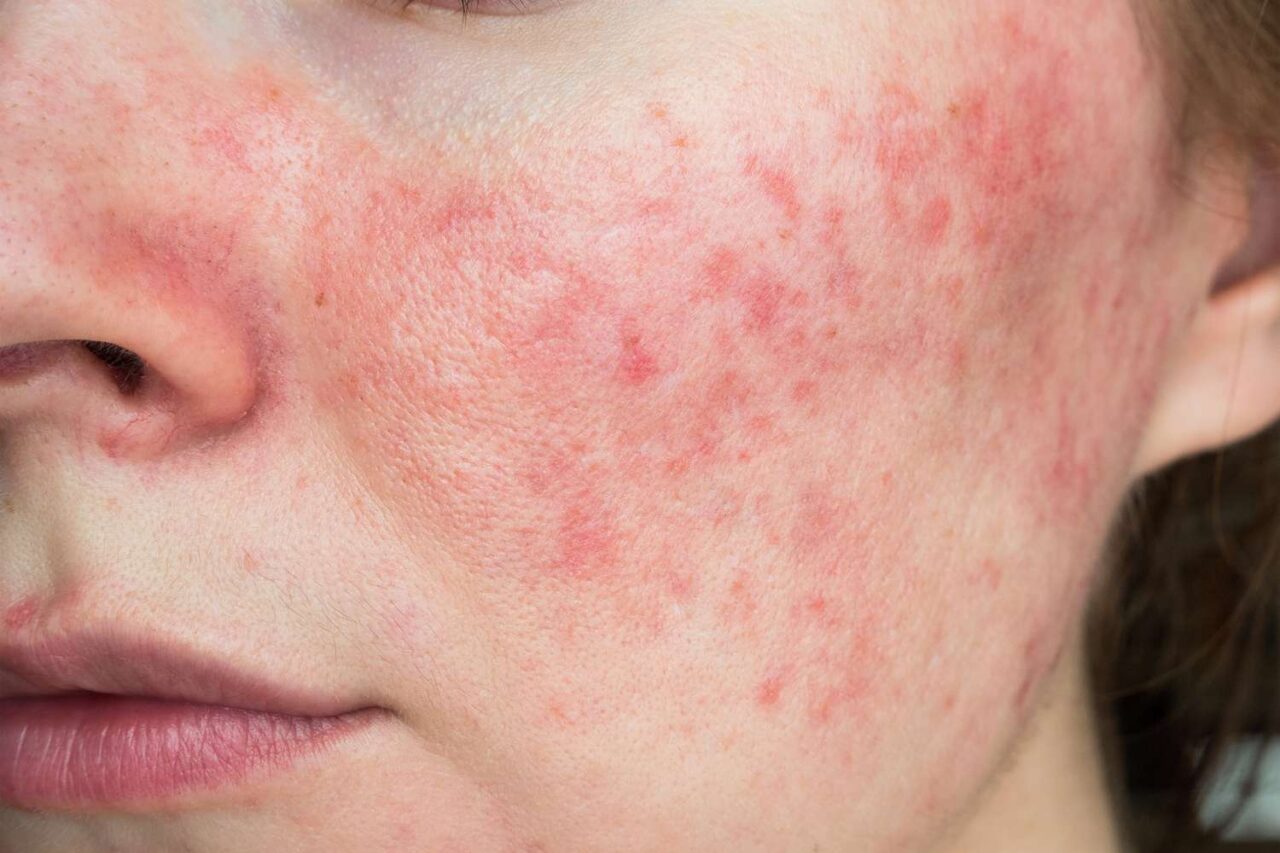 Close up of face with itchy rash.