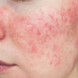 Close up of face with itchy rash.