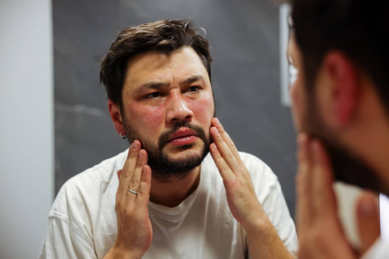 Man examines his hives in the mirror