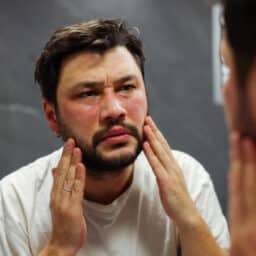 Man examines his hives in the mirror
